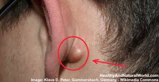 lump behind ear causes and treatments