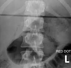 L4 and l5 fractures are commonly the result of a high impact trauma from falls or motor vehicle accidents.1 treatment for l4 and l5 fractures tend to be incident specific and differ from treatments of thoracolumbar and upper lumbar fractures.2. The Thoracolumbar Spine