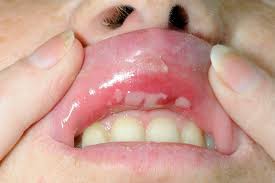aphthous ulcers inside upper lip