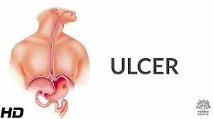 ulcer causes signs and symptoms