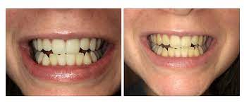 arc teeth whitening whitening kits
