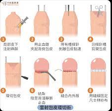 包皮、包莖開一槍小頭清爽不發炎