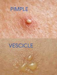 herpes vs hpv how are they diffe