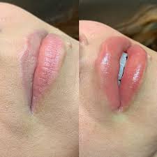 lighten dark lips permanently treatment