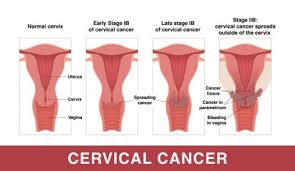 hpv cervical cancer causes symptoms