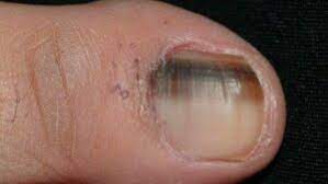 spotting a melanoma on the fingernail
