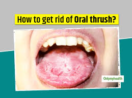 want to get rid of thrush here