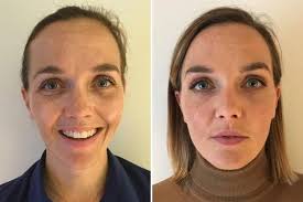 That's why you should only. Victoria Pendleton I Had 1 5k Face Fillers And Botox To Boost My Confidence After My Marriage Split But My Family Thought It Was Crazy