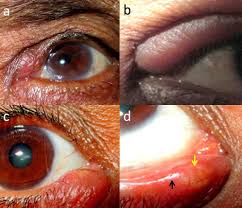 primary lacrimal ciculitis a