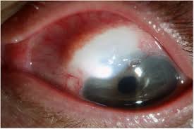 blebitis after cataract surgery