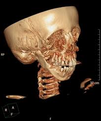 Treacher collins syndrome is a rare genetic condition that affects the development of the bones and tissues of the face. Treacher Collins Syndrome Radiology Reference Article Radiopaedia Org