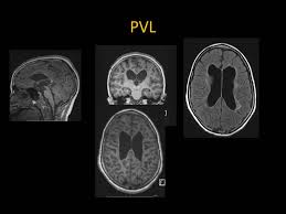 We did not find results for: Radiology Of Periventricular Leukomalacia