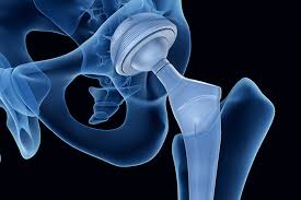 direct anterior hip replacements