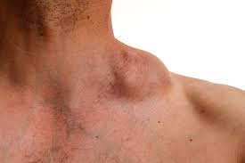 swollen lymph nodes are they signs of