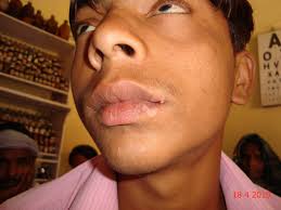 lip vigo with homeopathy