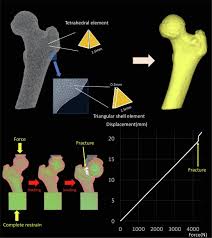 bone strength of the proximal femur