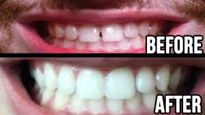 When the gap in front teeth is due to a missing tooth, a bridge or an implant is a great way to close this gap. Fixed My Teeth Gap Without Braces 45min Work Youtube