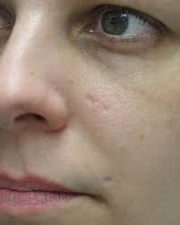 cover acne scars acne scar filler for