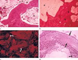 The authors briefly review its clinical. Typical Histologic Appearance Of Paget Disease A Lytic To Mixed Download Scientific Diagram