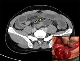 adhesive small bowel obstruction an