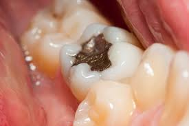 3 signs that your dental filling is