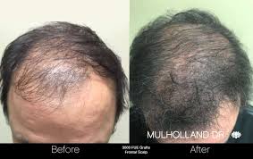Check hair transplant before and after pictures of hair transplantation treatments; Toronto Fue Follicular Unit Extraction Hair Transplant