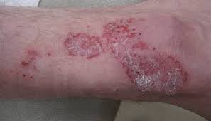 itchy burning rash that recurs on the