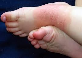 foot eczema causes symptoms