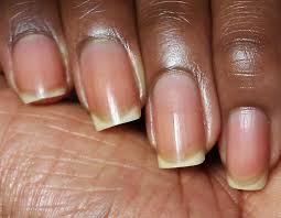 home remes for nail discoloration