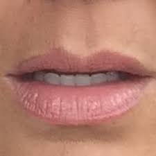 is this melasma on my upper lip line