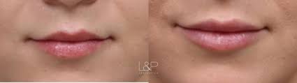 lip augmentation before and after photo