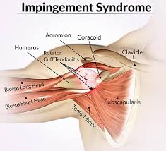 It covers the bones, ligaments, muscles and other structures that make up the shoulder. Nyc Shoulder Impingement Treatment Doctor Shoulder Specialist Sports Injury Clinic