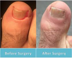 surgery for ingrown toenail treatment