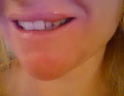 swelling on one side after lip filler