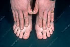 20 nail dystrophy syndrome stock