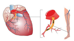 O infarto agudo do miocárdio é um quadro potencialmente grave que surge quando o fluxo de sangue que irriga o coração através das artérias coronárias é insuficiente, levando à necrose de parte do músculo cardíaco. Infarto De Miocardio Que Es Causas Sintomas Y Tratamiento Cardioalianza