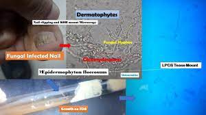 nail dermatophytes in nail cliiping koh