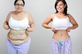 gastric sleeve before and after skin