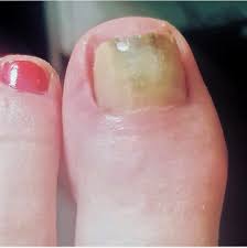 green nail syndrome the chelsea clinic