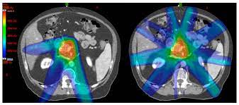 particle therapy for pancreatic cancer