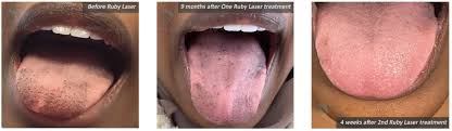 black spots on tongue and pigmentation