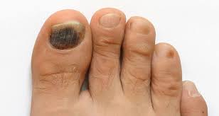 common toenail conditions east coast