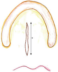 palatal fistulae