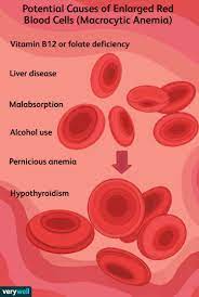 macrocytic anemia symptoms causes