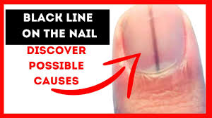 black lines on fingernails causes