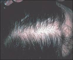 Male pattern balding stage 4: Alopecia In Women American Family Physician