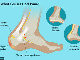 Possible causes, signs and symptoms, standard treatment options and means of care and support. Heel Pain Causes Treatment And When To See A Doctor