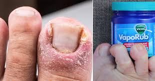 does vicks kill toenail fungus vicks