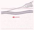intravenous injection