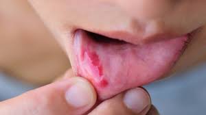 treating a mouth injury from braces